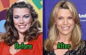 She managed to rein in her aging signs and traded them for a youthful . Has Vanna White Had Plastic Surgery Celebritysurgeryicon
