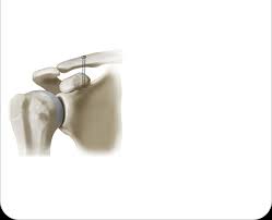 Image result for AC Dislocation