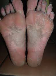 A Do It Yourself Peel For Dry Cracked Feet Foot Peel Baby Feet Peel Peeling Mask
