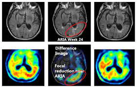Aducanumab is a human monoclonal antibody that has been studied for the treatment of alzheimer's disease (ad). Keep Your Enthusiasm Scientists Process Brutal Trial Data Alzforum