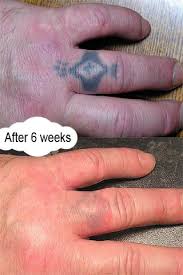 Laserless Tattoo Removal In 2020 At Home Tattoo Removal Diy Tattoo Permanent Diy Tattoo