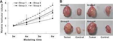Testicular cancer, a malignant spermatocytic seminoma, computer illustration and light micrograph. Increased Efficiency Of Testicular Tumor Chemotherapy By Ultrasound Microbubble Mediated Targeted Transfection Of Simdr1
