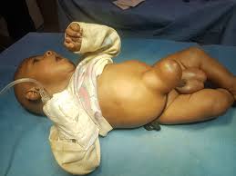 Image result for Inguinal hernia child