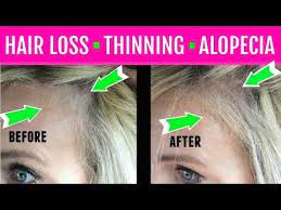 This is a medical condition and a dermatologist has the highest training in the diagnosis and management of hair loss. Stop Hair Loss Regrow Hair 6 Week Results Easy Fix Youtube Hair Loss Women Regrow Hair Stop Hair Loss
