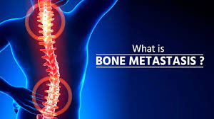 Check spelling or type a new query. What Is Bone Metastasis Stage 4 Cancer Bone Metastasis How Cancer Spreads Metastasis Youtube