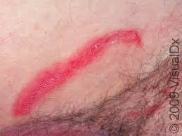 Image result for sore skin in the groin area