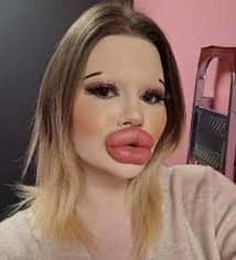 Woman With World's Biggest Lips Now Wants Huge Cheekbones. Check comments  for more👇🏻