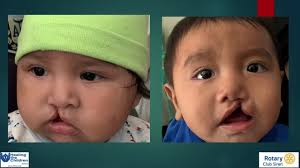 In honor of giving Tuesday, I thought I’d share an opportunity for my  LinkedIn connections. In the past year, I’ve been working with a surgeon  (Dr. Steven Roser) from Emory Academic Medical Center in… ...