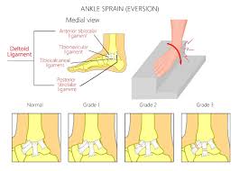 Some swelling and marked joint instability. Sprains