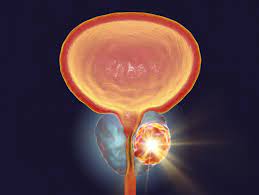 There might be swelling or a buildup of fluid in the feet or legs, random weight loss, fatigue, or change in bowel habits. Advanced Prostate Cancer Stages Risk Factors Symptoms And Treatment