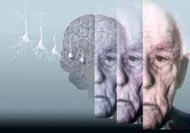 Want an easy way to describe and understand the symptoms of alzheimer's disease? Alzheimer Demenz Die Forschung Steht Unter Druck