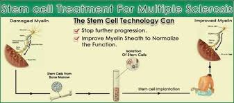 Corticosteroids used to treat ms include methylprednisolone (intravenous) and prednisone. Stem Cell Treatment For Multiple Sclerosis In Turkey Find Best Hospitals Cost Estimate