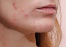 Image result for Seborrheic Dermatitis