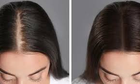 ‫زراعة الشعر للنساء قبل وبعد بأفضل نتيجة 2024 - مركز تركي هير مصر‬‎