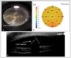 Image result for Gonioscopy