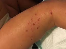 Image result for Atopic eczema atopic dermatitis