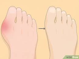 Vitamin yang boleh membantu mengatasi masalah gout ini adalah vivix dari jenama shaklee. Cara Mengatasi Penyakit Gout Dengan Gambar Wikihow