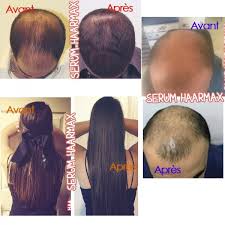 Even if it doesn't help against hair loss, i hope i can still use it to get rid of the big dark spots i got had acne/pimples on my head. Hair Growth Serum And Its Derma Roller Haarmax
