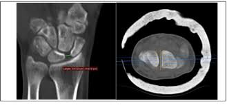 Image result for Scapholunate Dislocation