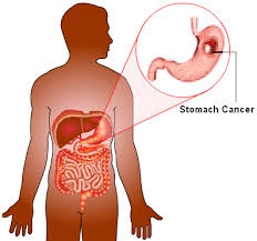 Symptoms of early stomach cancer can be similar to the symptoms of other conditions, such as stomach ulcers. What Are The First Signs Of Stomach Cancer Quora