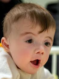 Surgeons remodel skulls of boys born with rare disorder