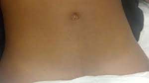 Several treatments are needed for desired results. Before And After Laser Hair Removal Photos
