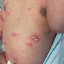 Thanks so much for hanging out with me today while i share with you all of the woes. Visual Diagnosis A Neonate With Rash And Fever American Academy Of Pediatrics