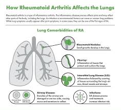 Image result for Rheumatoid Factor