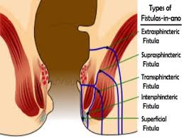 This surgery is performed under general anaesthetic. Searching Similimum In Fistula In Ano Homeopathy360