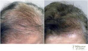 Microneedling stimulates dormant hair follicles. Non Surgical Hair Loss Therapy In Gilbert Az Gilbert Med Spa Serving Mesa Chandler Tempe