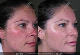 Zuckerman's cheek enhancement patients in new york city. Cheek Augmentation Facelove