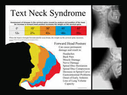Details About Text Neck Syndrome Poster Chart Chiropractic Forward Head Posture Position