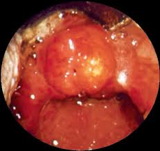 Image result for Acute Laryngitis