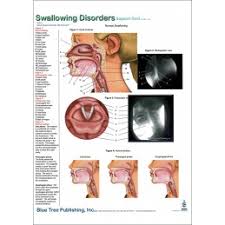 Swallowing Disorders Anatomical Chart