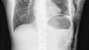 Image result for Emphysema