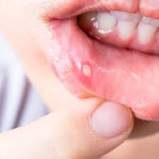 Some symptoms of mouth cancer are noticeable, that makes it possible to detect mouth cancer in its early stages. Symptoms Mouth Cancer Foundation