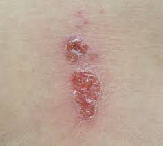 Image result for genital herpes