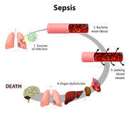 This initial stage is followed by suppression of the immune system. Sepsis Vektor Abbildung Illustration Von Arthritis Bakterium 55481452