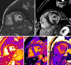 Nach 5 tagen klinikaufenthalt die entlassung. Kardiale Magnetresonanztomographie Springerlink