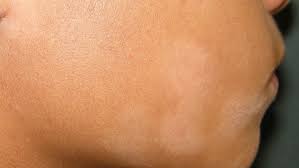 Witte vlekken op de huid (pityriasis alba) rode bultjes op bovenarm of benen (keratosis pilaris). Pityriasis Alba Symptoms Causes Diagnosis And Treatment