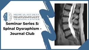 Image result for Spinal Dysraphism