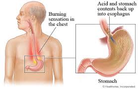 When you have gerd (chronic acid reflux) your stomach acid persistently flows back up into your mouth through your esophagus. Gastroesophageal Reflux Disease Gerd My Doctor Online