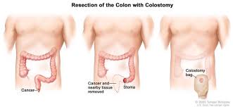 Colorectal cancer affects the colon and rectum. Anal Cancer How To Diagnose Staging Treatment Dana Farber Cancer Institute Boston Ma