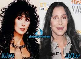 Find out which plastic surgery procedures are performed most often. Cher Plastic Surgery Before And After Photos Plastic Surgery Facts