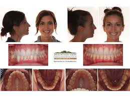 We did not find results for: Adult Treatment Examples Mountain View Orthodontics Longmont Berthoud Co
