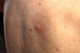 Find & download free graphic resources for mosquito bite. How To Identify Mosquito Bites Tick Bites Spider Bites And More