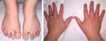 Image result for Dactylitis