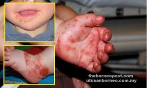 Ia boleh ditemui di dalam saluran hidung dan tekak, cecair di dalam kesan melecet dan najis orang yang dijangkiti. Ibu Bapa Harus Sedar Bahaya Penyakit Hfmd Utusan Borneo Online