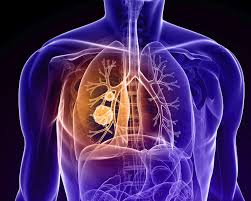 Your details are safe with cancer research uk in memory of thanks for visiting my fundraising page. Frontline Durvalumab Chemotherapy Shows Promising Activity In Mesothelioma