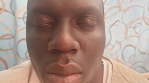 Check spelling or type a new query. Isolated Facial Diplegia A Rare Presentation Of Guillain Barre Syndrome Authorea